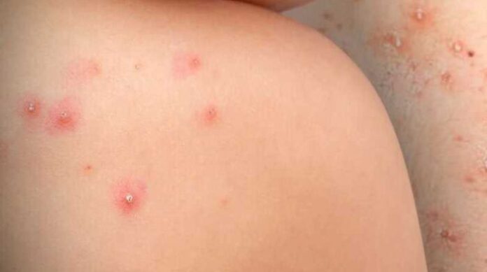 Los casos acumulados de la viruela del mono en Perú ascienden a 1.068, según las últimas cifras transmitidas por el Ministerio de Salud del país andino