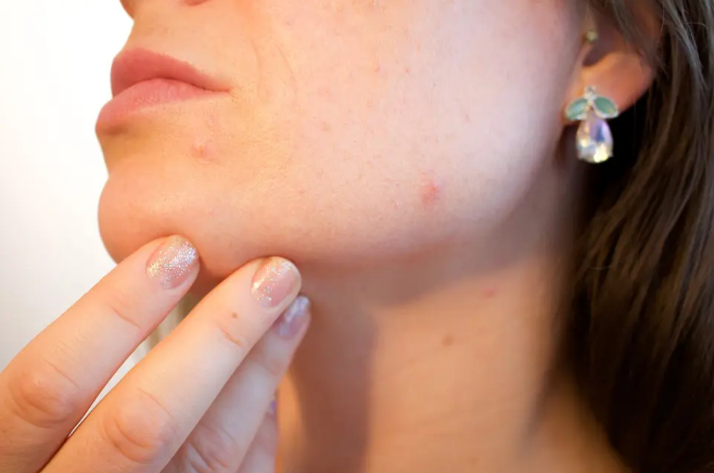 Logran reducir las cepas de las bacterias de la piel que causan el acné