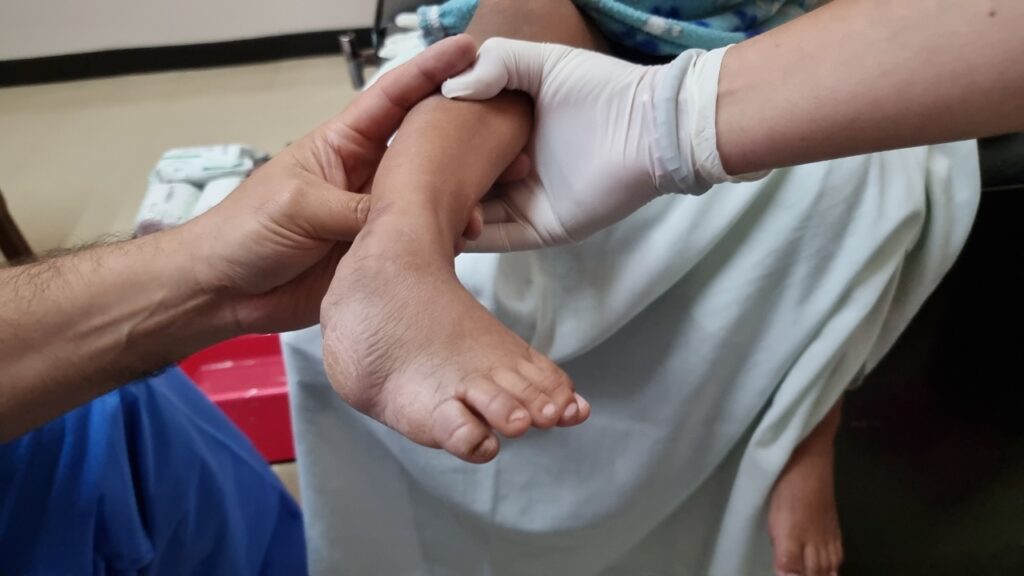 Pie Equino Varo, afección que se puede solucionar sin cirugías Diario El Mercurio