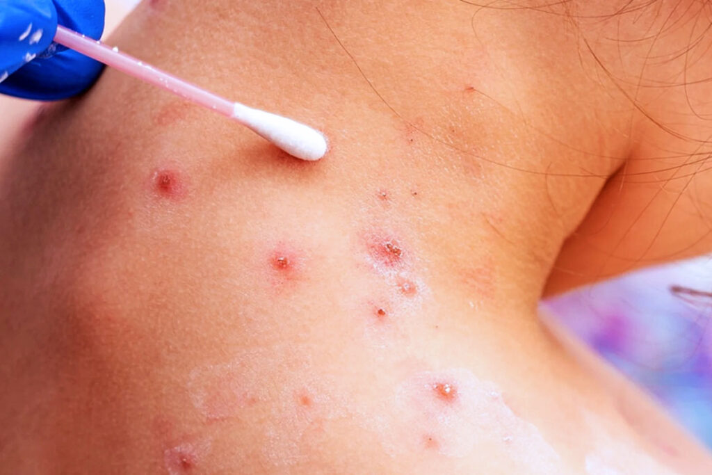 Viruela del mono Ecuador