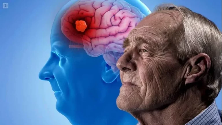 Nuevo ensayo confirma la eficacia de fármaco experimental contra el alzhéimer