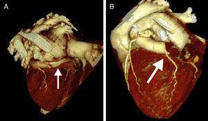 Grupo de científicos halla el origen de las fístulas coronarias congénitas