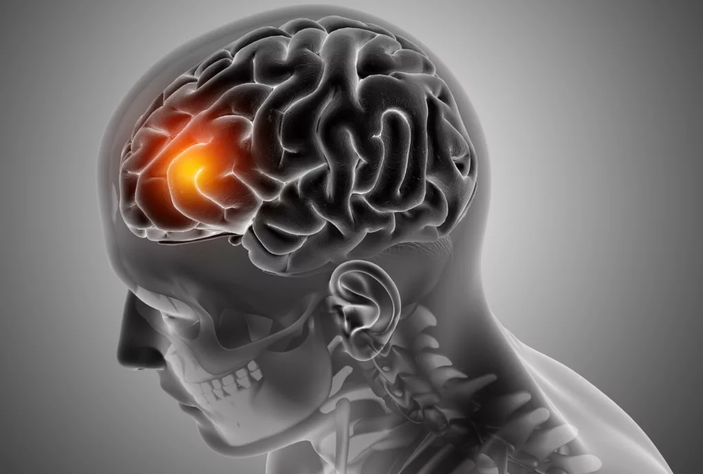 Imagen referencial. Los ictus o accidentes cerebrovasculares podrían causar casi 10 millones de muertes al año para 2050. Foto: Freepik