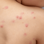 La Organización Mundial de la Salud (OMS) declaró el actual brote de mpox (conocido antes como viruela del mono como una emergencia de salud pública de alcance internacional.