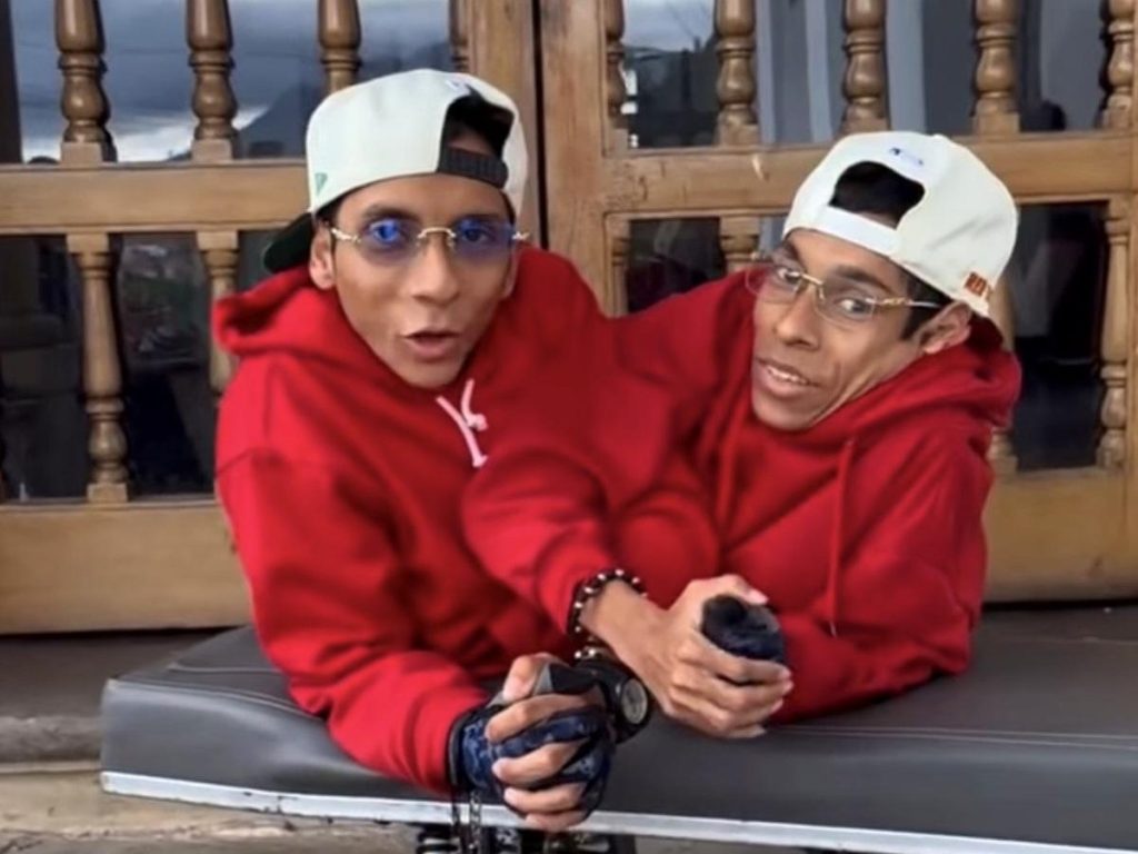 Son José Luis y José Armando Cevallos, hermanos siameses de Ecuador, que fallecieron en Colombia